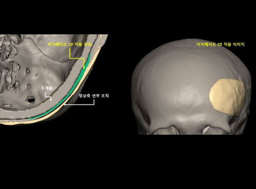 이지메이드-CF 두개골 수술 이미지