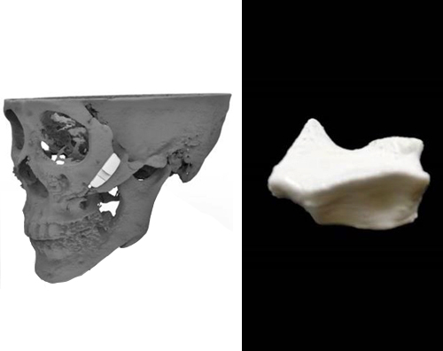 CG Bio Receives Approval for 3D Printed Cheekbones