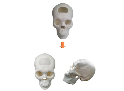 시지바이오, ‘특수재질두개골성형재료’ 의료기기 품목 허가 승인