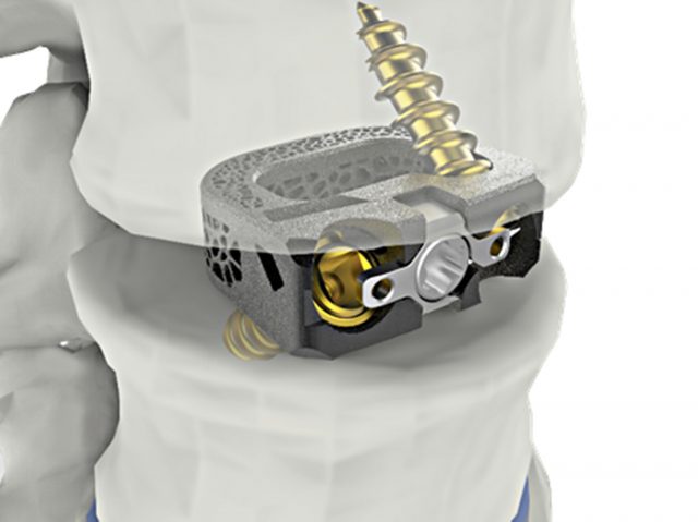 시지메드텍, 척추 임플란트 ‘유니스페이스’ FDA 승인… 노보시스 美 임상 성공 앞당긴다